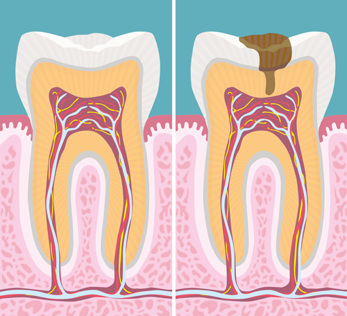 Root Canal Surgery